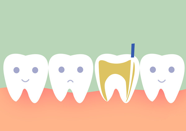 根管治疗